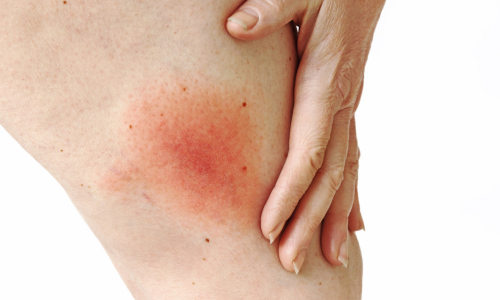 tick-bite-text-image-1